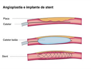 Radiologia Intervencionista: tire suas dúvidas sobre Angioplastia e Colocação de STENT