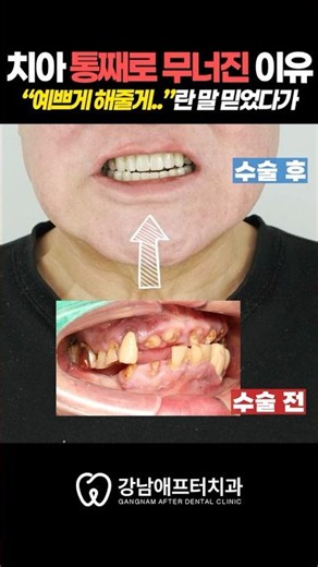 Tricked by the promise of a "pretty smile" 😢 The reason my teeth completely collapsed #GangnamDen...