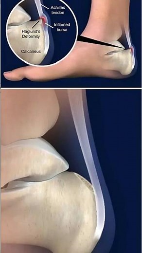 Pump Bump Haglund’s Explained #foothealth #achillespain #heelpain #healthtips #healthawareness