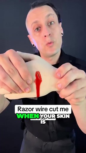 Quick Wound Closure Rapid Healing Tips for Deep Cuts | kieram litchfield