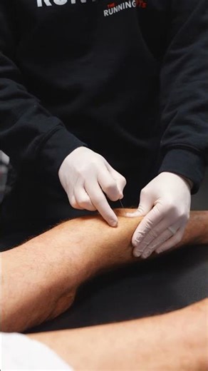 Dry Needling for Tight Calves