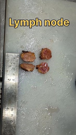 Lymph node biopsy sample| #histopathology #cervicaltreatment #cervicalnode #cervicalpain #cervicaltb