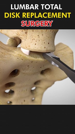 Disc replacement surgery 3d animation #slipdicstreatment #spinesurgery #lumbardiscreplacement #discreplacement #slipdiscsurgery #herniateddisc #medical3danimation #3dmedicalanimation #animed #surgery