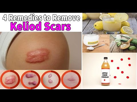 Keloid Scar Removal at Home: 4 Remedies for Treatment of Scars!