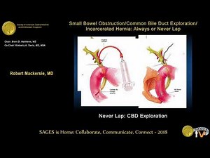 Common bile duct exploration: Never laparoscopically