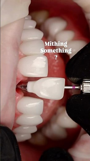 Mithing Something? 😜 Front Tooth Implant Transformation