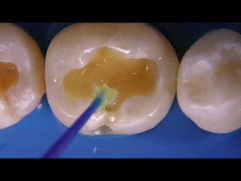 three step etch & rinse adhesives