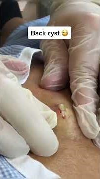 Infected cyst! #pimple #extraction #popping #skincare #cyst #whiteheads #blackheads