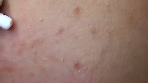 8.7K views · 62 reactions | Acne Treatment on the face #22  WATCH...
