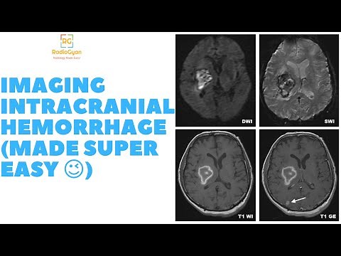 Brain Hemorrhage CT / MRI (Made Super Easy!) - Radiology Video Tutorial!