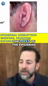 Did you know that there are seven different types of eczema? Get an overview of each and what to do about them from ecz-pert dermatologist Dr. Eric Simpson. Watch the full webinar: https://nationaleczema.org/webinar-introducing-the-7-types-of-eczema-and-what-to-do-about-them/ | National Eczema Association