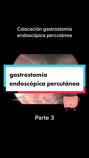 Colocación de gastrostomía endoscópica percutánea. Parte 3 #anatomía #salud #medicina #human #medicine #doctor #fyp