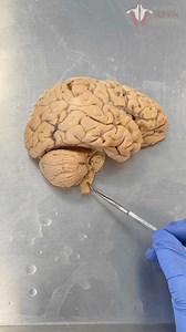 Institute of Human Anatomy on Instagram: "In this live stream we used an amazing brain dissection to discuss the hollow spaces in the brain that create the ventricular system for cerebrospinal fluid flow and production. . . #instituteofhumananatomy #anatomy #anatomylab #anatomyclass #cadaver #cadavers #cadaverlab #learninganatomy #learnanatomy #physiology #physiologyclass #biology #biologyclass #science #scienceclass #learn #learning #ventricle #csf #cerebrospinalfluid #neuroscience #neuro #brai