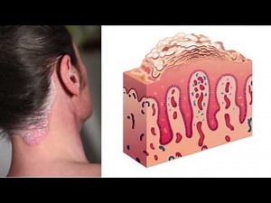Psoriasis - What is it?