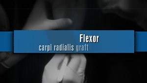 “FIRST" ARTHROSCOPIC LIGAMENTOPLASTY TECHNIQUE FOR SCAPHOLUNATE INSTABILITY