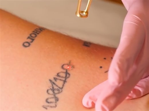 How Tattoos Are Removed Professionally | Health is Wealth