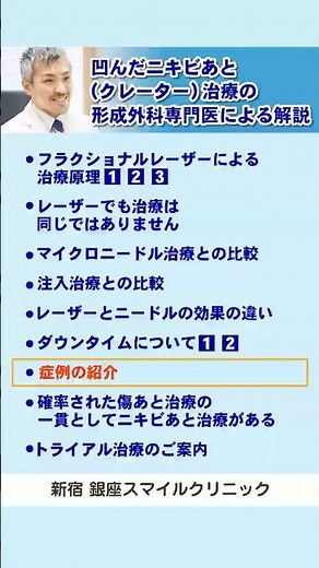 凹んだニキビあと治療の形成外科専門医による解説[7]症例紹介 #ニキビ跡 #クレーター #美容