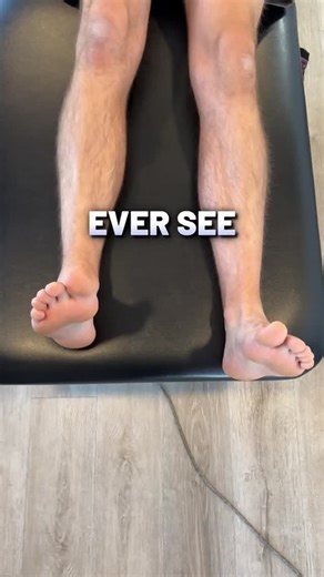 Zac Cupples on Instagram: "Think one of your legs is shorter than the other? 👀 You’re not alone. True leg length differences happen. But often it’s not the bones. Tight muscles around the pelvis can hike one side up. That creates the appearance of a shorter leg. This shift limits hip motion and changes how you walk. Random stretching won’t fix it. Target the imbalance and restore pelvic position 🧠 When the pelvis evens out, movement feels smoother 💪 Comment “MOVE” to get 49 days of free mobil