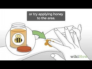 How to Stop Mosquito Bites from Itching