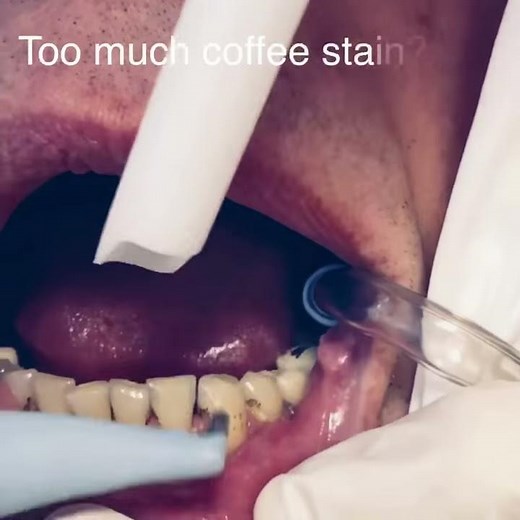 Airflow Teeth Scale and Cleaning