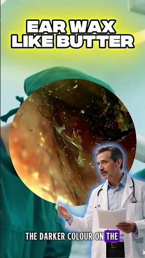 Why Earwax Builds Up and How to Clean It Safely