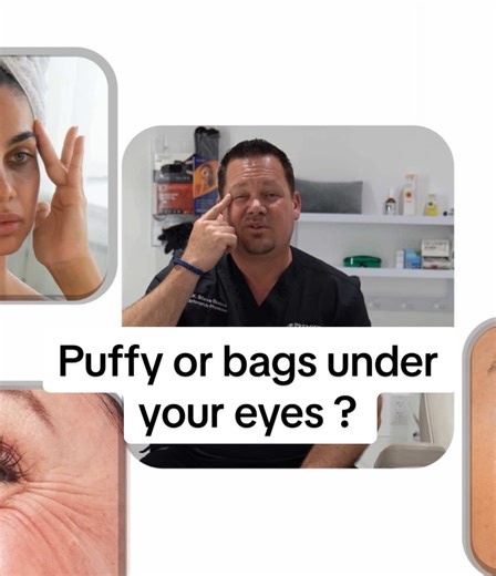 Red, puffy eyes aren’t always about allergies or lack of sleep. Often, the real cause is clogged meibomian glands in your eyelids. When these glands get blocked, they can’t produce the oils your eyes need, leading to chronic redness, puffiness, and irritation that won’t go away on its own. The Clear Lids program works by gently extracting that buildup from the glands, restoring proper function and giving the eyes a noticeably clearer, healthier appearance. It’s one of those treatments most peopl