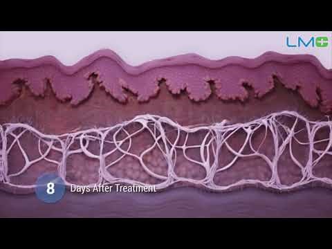 HIFU non-surgical face procedure for face lift and skin tightening