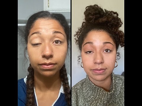 My Frontalis Sling Surgery (24 Yrs Old)