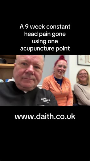 9 week constant head pain gone using one auricular acupuncture point #migraine #migrainerelief #daith #daithpiercing #migrainepiercing #migraineharleystreet #daithmigraine