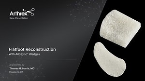 Flatfoot Reconstruction With AlloSync™ Wedges