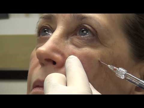 Midface Rejuvenation Filler | Dr. Mark Glasgold