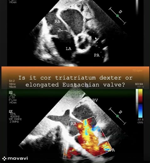 Is it cor triatriatum dexter or elongated Eustachian valve? (s)