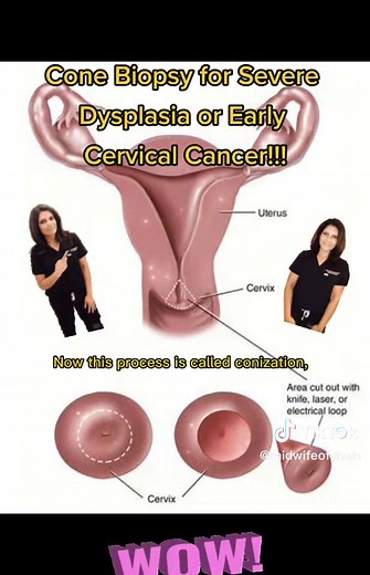 Cone Biopsy for Severe Dysplasia or Early Cervical Cancer!!! #conebiopsy #coldknifecone #coldknifeconebiopsy #dysplasia #cervicalcancer #carcinomainsitu #cervicalbiopsy #cervicaldysplasia #abnormalpapsmear #abnormalpap #hpv #papsmear #cancerprevention #cervix #cervicalcancerawareness #gyn #gynecology #fypシ #fyp #fypage #explore #explorepage, #cnm #midwives #womenshealth https://my.clevelandclinic.org/health/diagnostics/23381-cone-biopsy#:~:text=Conization (cone biopsy) and LEEP,cervix using a su