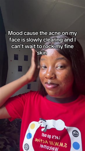 The Joy of Clear Skin: My Acne Journey