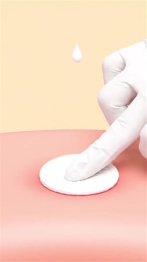 #asmr #zitpopping #satisfying #skincare #relax #pimple