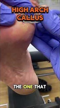 A satisfying treatment today removing a painful callus under the plantar fifth metatarsal head, with