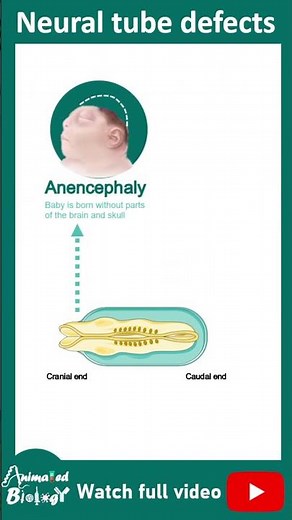 Neural tube defects | 1 minute pathology