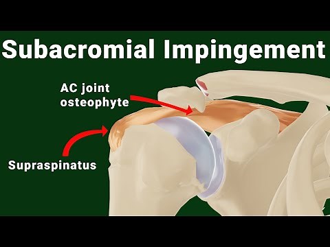 Subacromial impingement of the shoulder (animated)