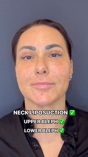 Dr. Neophytos Demetriades on Instagram: "ALL IN ONE : TRANSFORMATION 👄🔥 1. Smart Lipo (Neck liposuction) 2. Upper Blepharoplasty 3. Lower Blepharoplasty Check out the results ‼️ All done with local anesthesia, in the office! ☎️Nicosia/ Limassol/ Paphos: 7000 7484 ☎️From abroad: +357 70007484 🌍Website: www.cyprusfacialsurgery.com 📩 info@cyprusfacialsurgery.com 📹 YouTube: CyprusFacialSurgery CFSyq 👥Skype: Cyprus Facial Surgery 📍Location: Cyprus (Nic-Lim-Pap) & Greece (Athens), US (NewYork) 