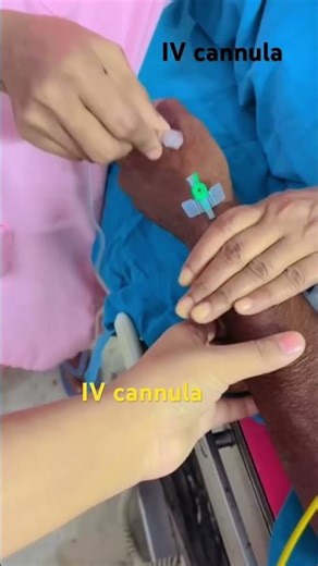 I.V cannula insertion #🩼 I.V cannulation #IV #Intravenous #. Iv injection #IV saline