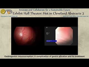 Gastrogastric intussusception: A complication of gastric plication and its treatment