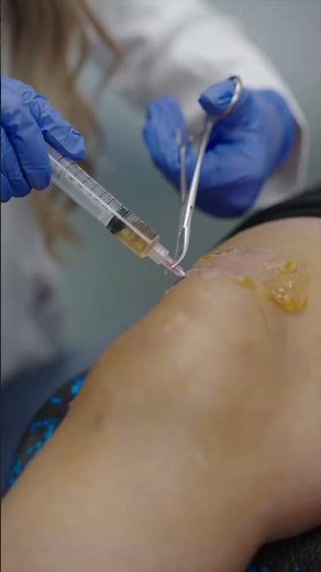 Knee Joint Aspiration and Injection with Ultrasound Guidance