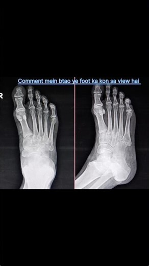 Foot X-Ray AP & Lateral Views | Basic Radiology 🔥 #radiology #footxray #medicalimaging #viralshorts