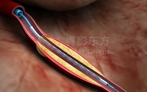 【3D医学动画】冠状介入治疗，PCI手术动画演绎，