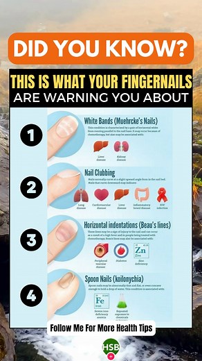 12K views · 77 reactions |  Nail Health Revealed: Unlocking the Clues to Your Well-being!   The Nail Doctor is In: Discover the secrets that your fingernails hold as we delve into the realm of nail health analysis. From color variations to texture, thickness to shape, we'll explore how these characteristics can indicate potential underlying health conditions. #DidYouKnow #signs #healthtips #health | Health Spirit Body | Facebook