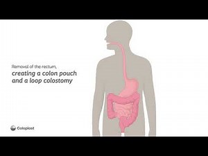 Creation of loop colostomy and colon pouch by removing rectum | Ostomy surgery | Coloplast India