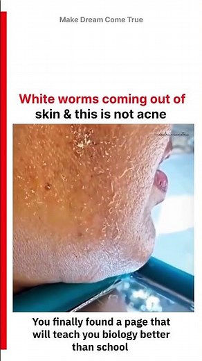 🪱 White worms coming out of skin 🪰 & this is not acne 🥚| MDCT