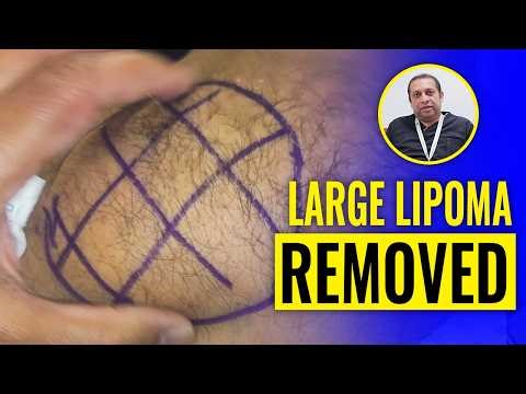 Large Lipoma of Back Removed - Complete Surgery - 3 Week Results
