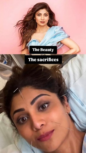 Shilpa Shetty posted a picture of her, where Shilpa Shetty underwent acupuncture, a traditional Chinese medicine technique. Fine needles are inserted into specific points on the skin to stimulate nerves, muscles, and connective tissue. | Daily Truly Times