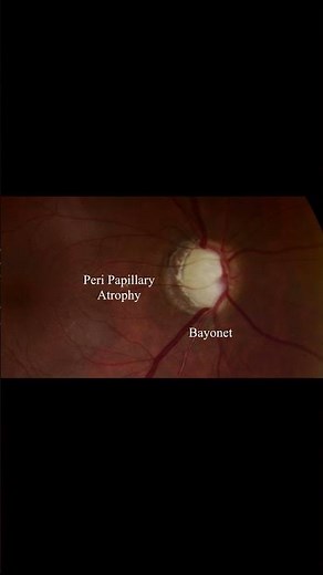 The Optic Disc Chronicles